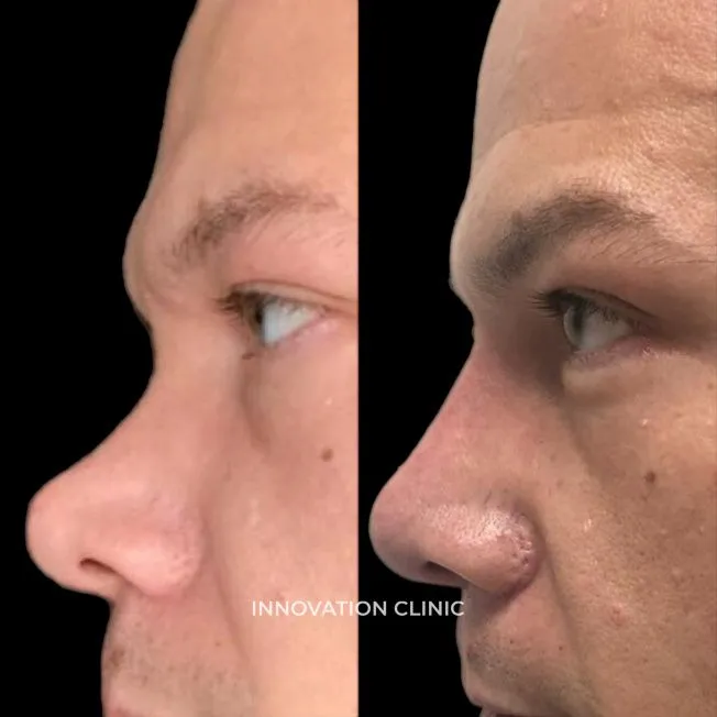 Коррекция спинки носа филлером фото до и после 4