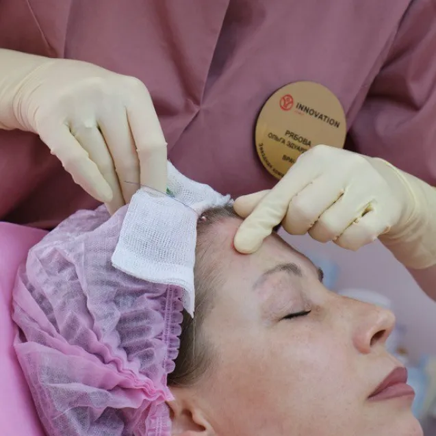 Нитевой лифтинг век