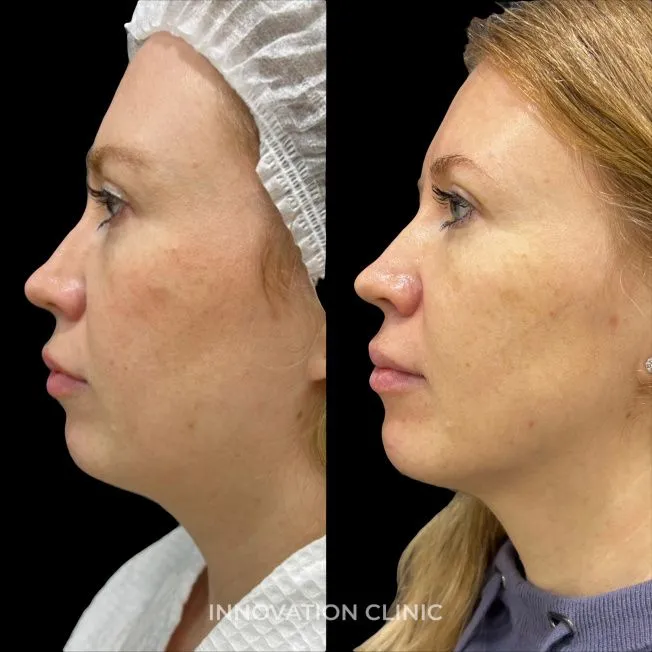 УЗ SMAS-лифтинг нижней трети лица фото до и после 2