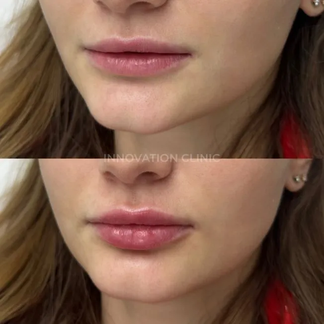Коррекция формы губ филлером фото до и после 16
