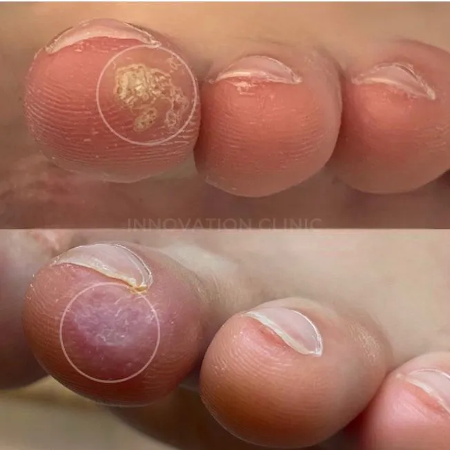 Удаление бородавок фото до и после