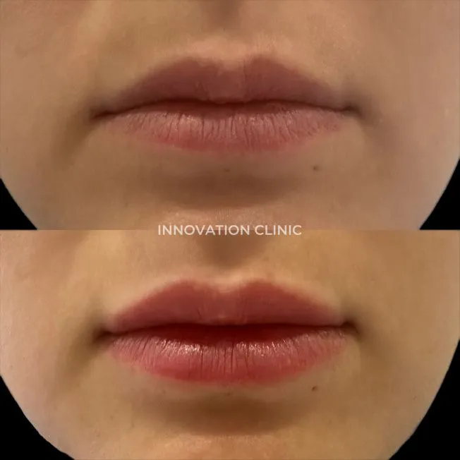 Коррекция формы губ филлером фото до и после 21