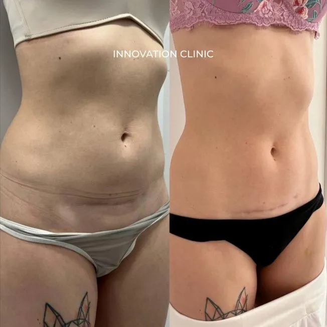 Микроигольчатый РФ-лифтинг живота Morpheus 8