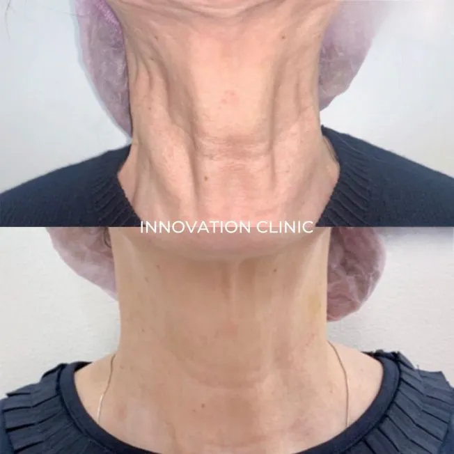 Устранение платизмарных тяжей фото до и после 2