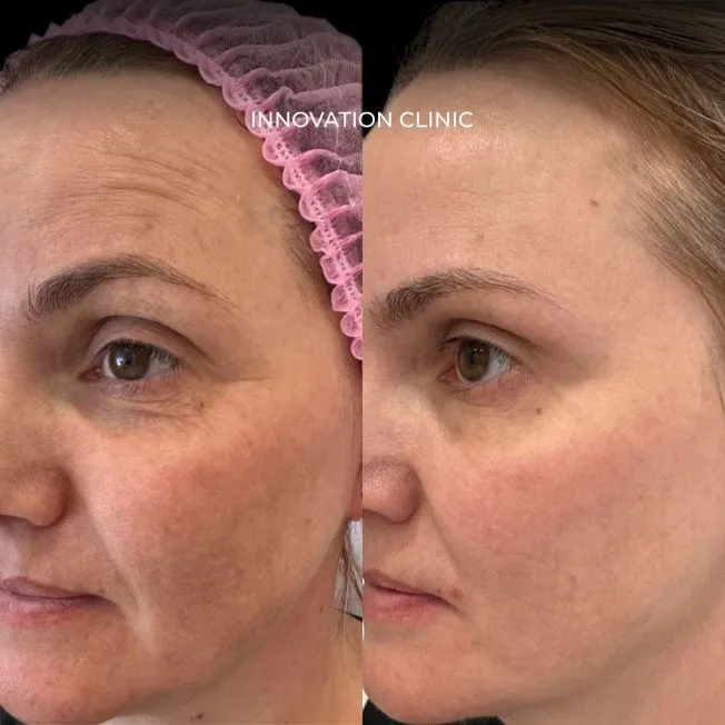 Комплекс процедур для лечения пигмента и омоложения