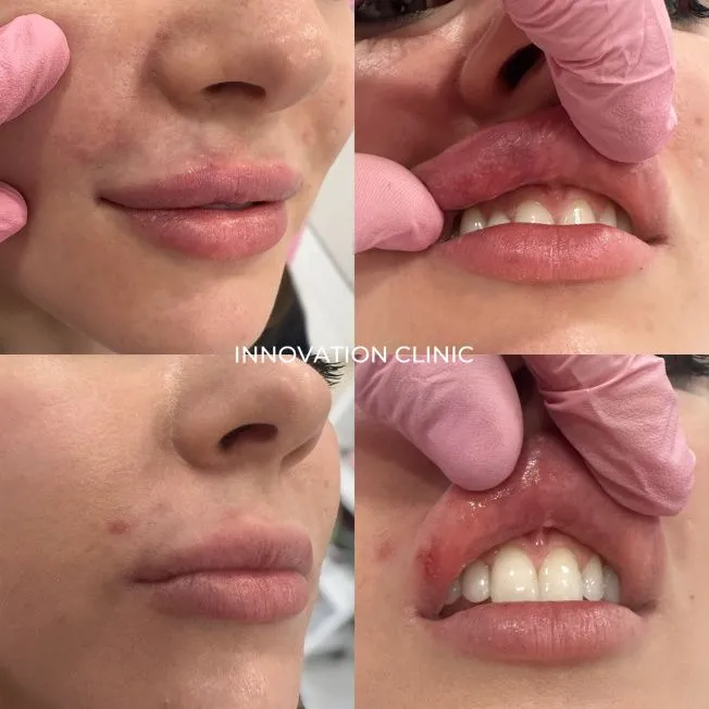 Лечение сосудистой эмболии фото до и после 2