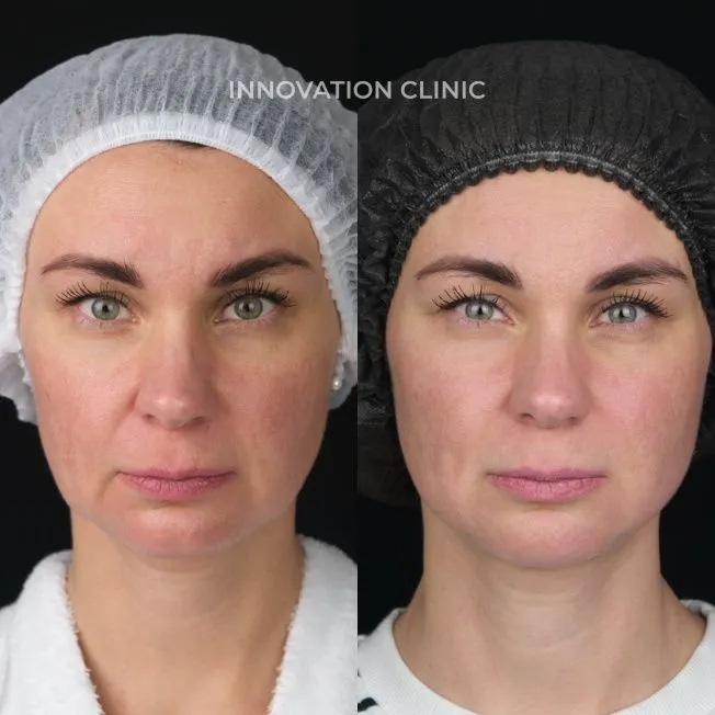 Монополярный RF-лифтинг Volnewmer фото до и после 2