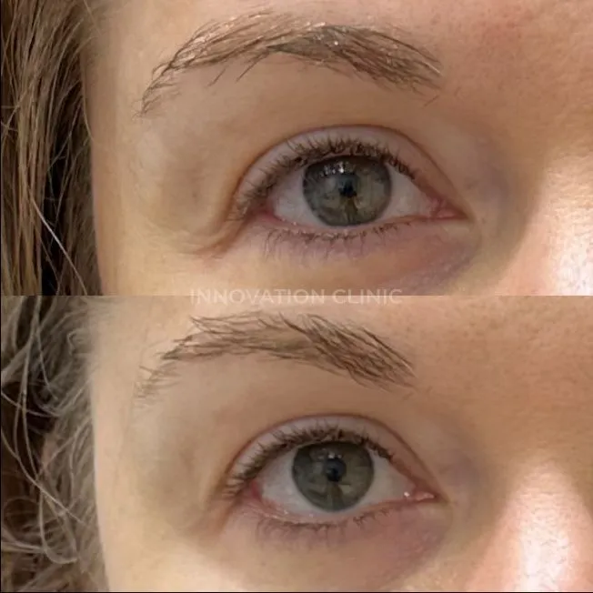 УЗ SMAS-лифтинг верхнего века фото до и после