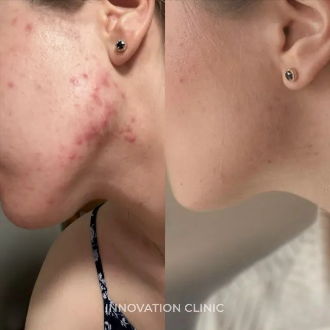 Комплексное лечение акне фото до и после 10