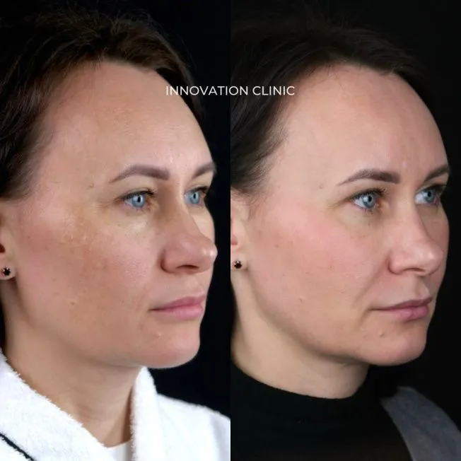 Протокол лечения пигментации фото до и после 