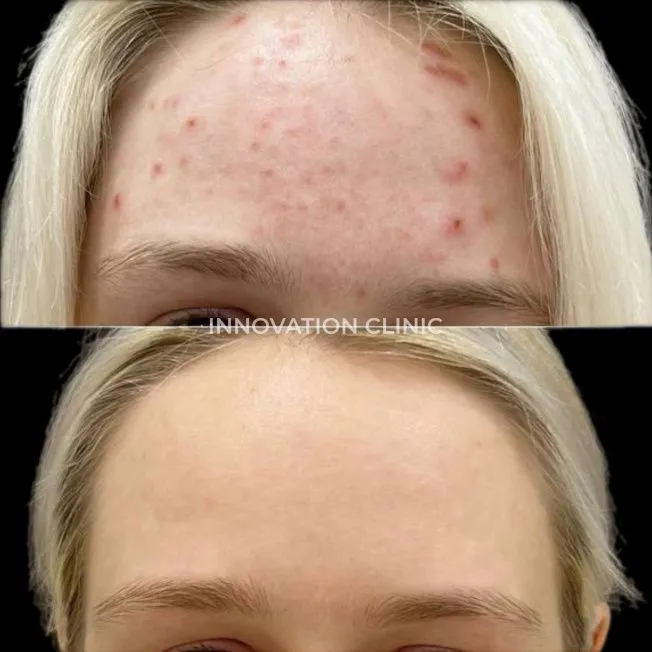 Комплексное лечение акне фото до и после 2
