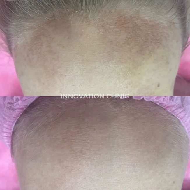 Лечение пигментации фото до и после 3