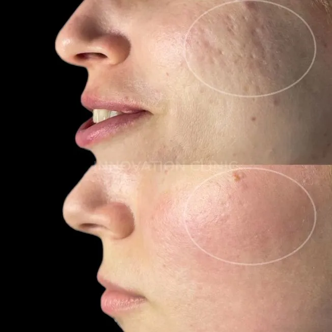 Лазерная шлифовка лица фото до и после 1