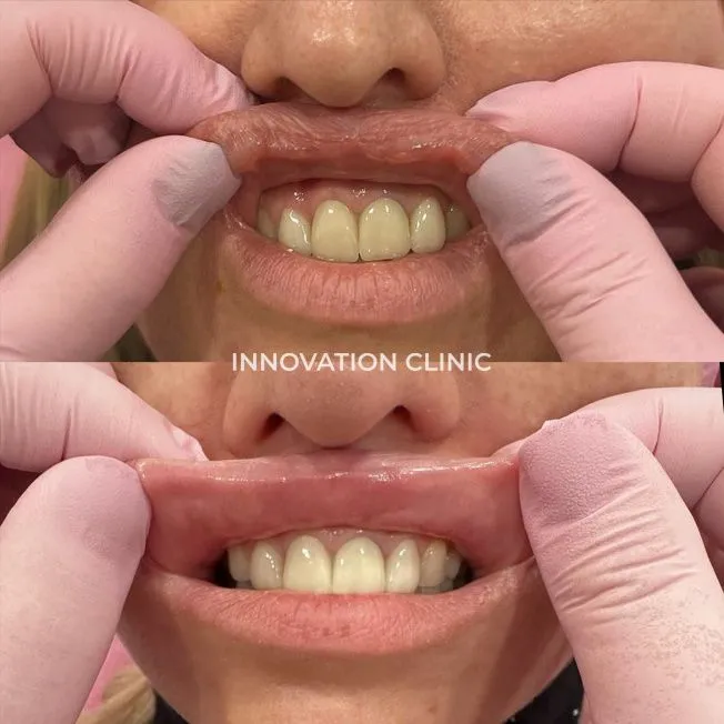 Удаление мигрировавшего филлера фото до и после 1