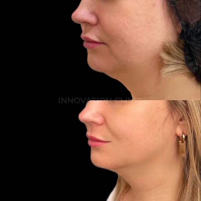 УЗ SMAS-лифтинг нижней трети лица фото до и после 8