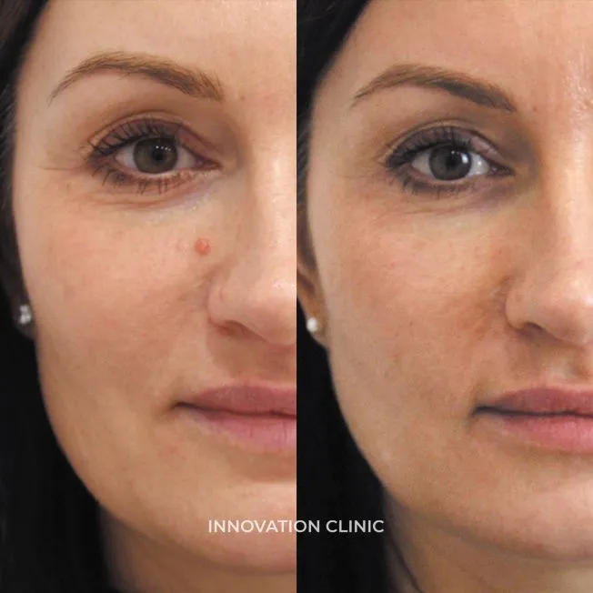 Удаление новообразований фото до и после