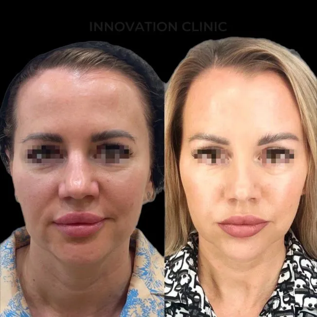 УЗ SMAS-лифтинг нижней трети лица фото до и после 6