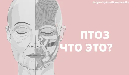 Птоз лица