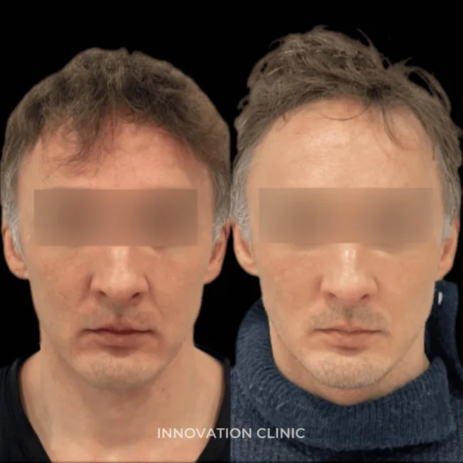 Нитевой лифтинг лица фото до и после 11