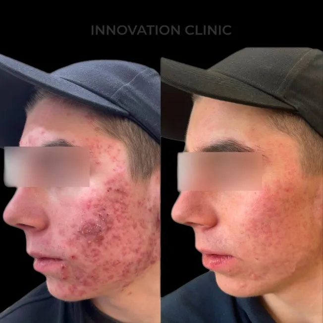 Комплексное лечение акне фото до и после 24