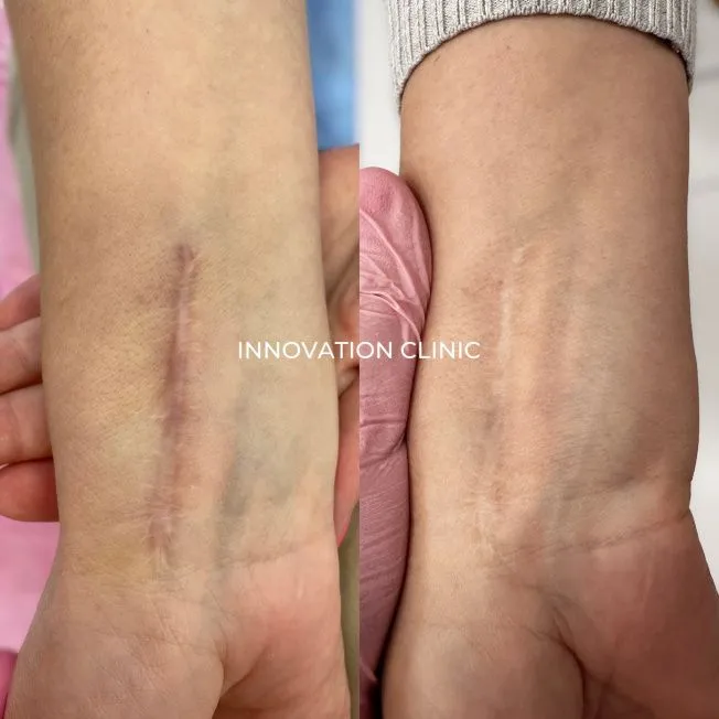 Лечение гипертрофических посттравматических рубцов фото до и после