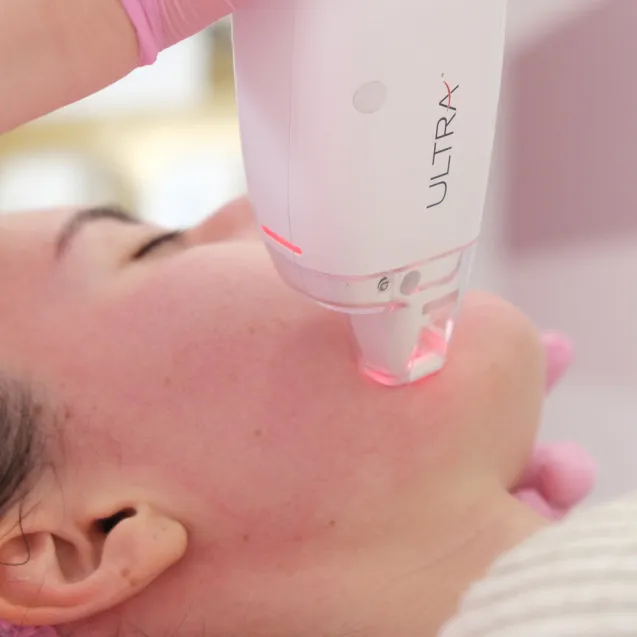 Лазерная шлифовка шрамов