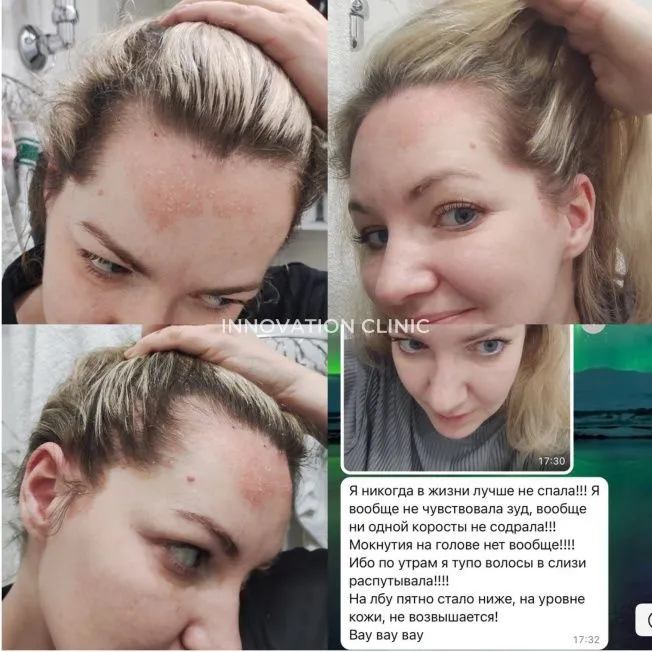 Лечение псориаза фото до и после