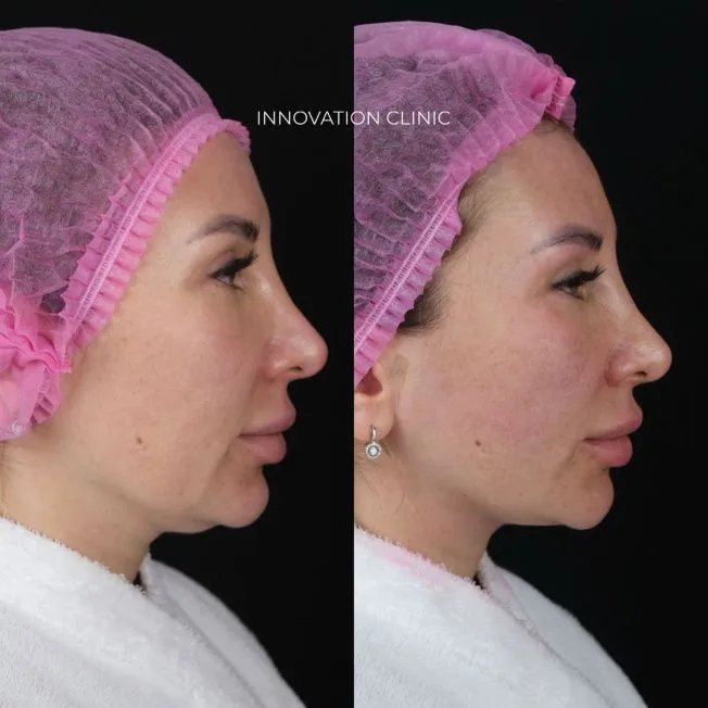 Лифтинг нижней трети лица нитями Aptos  