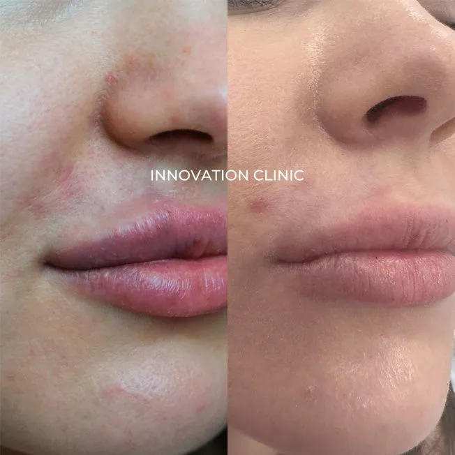 Лечение сосудистой эмболии фото до и после 1