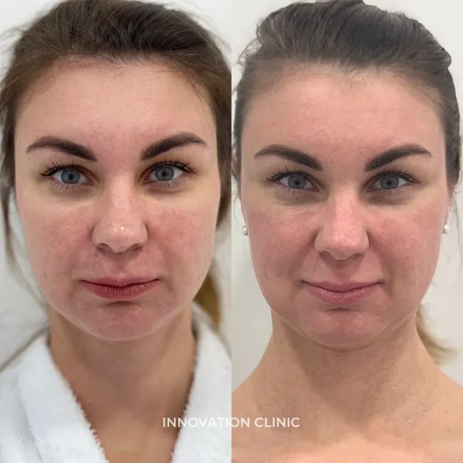 Лазерная шлифовка лица фото до и после 6