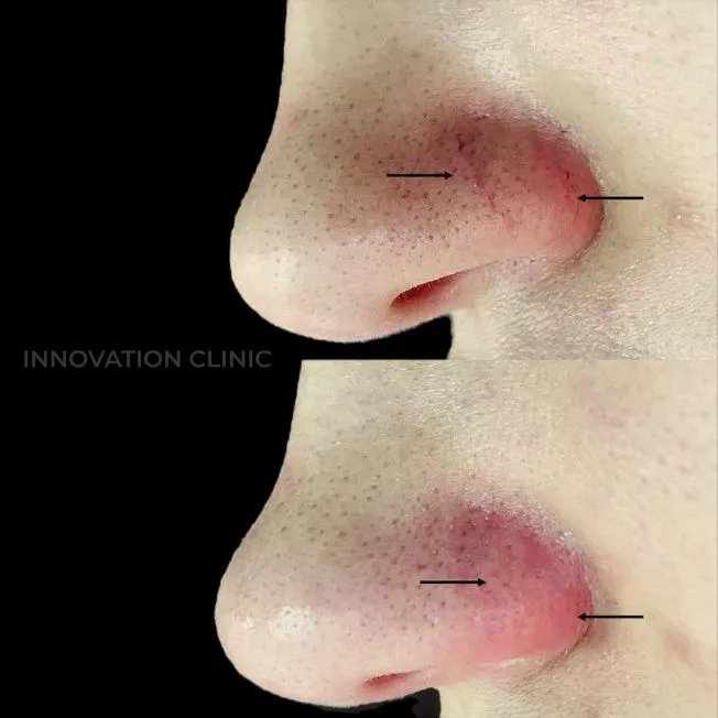 Устранение сосудистых патологий кожи фото до и после 3