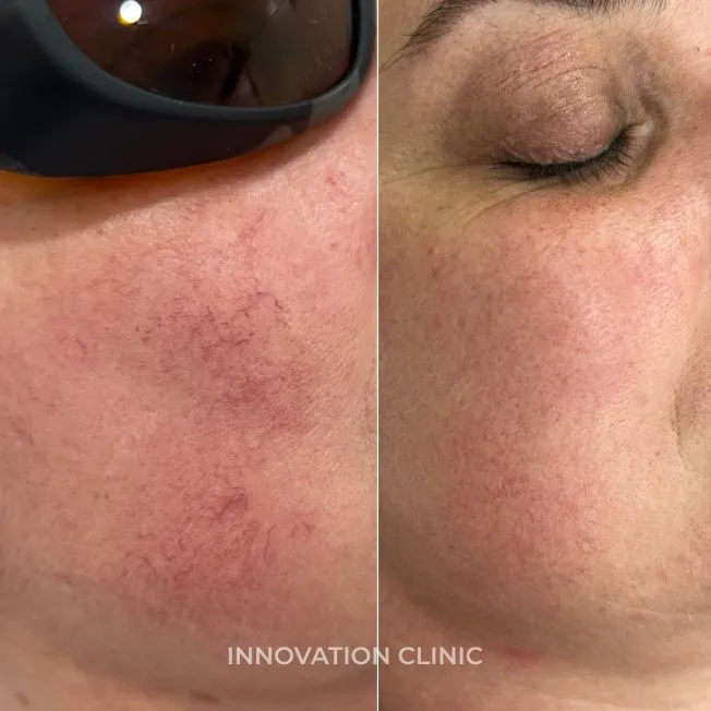 Устранение сосудистых патологий кожи фото до и после 1