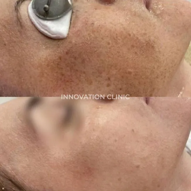 Сочетанный протокол фототерапия BBL фото до и после 2