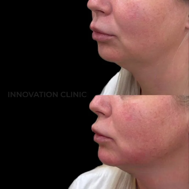 Коррекция нижней трети лица фото до и после 2