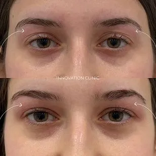 Коррекция формы верхнего века фото до и после