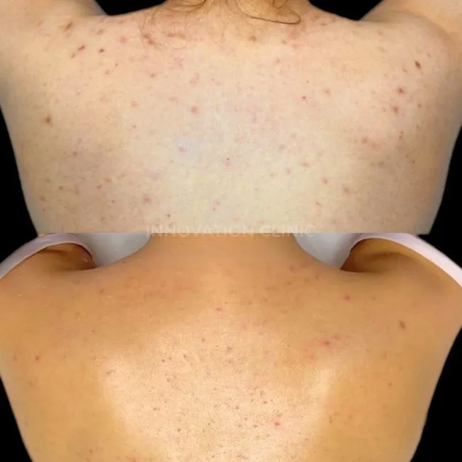 Комплексное лечение акне фото до и после 22