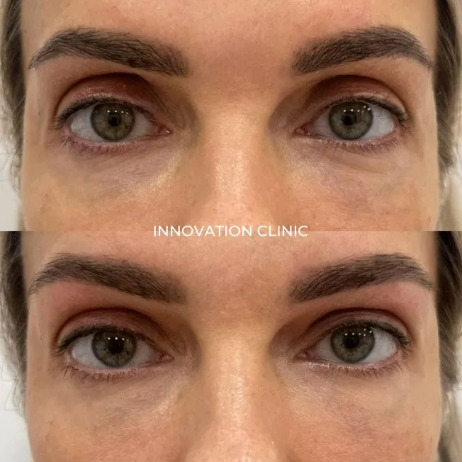 Коррекция формы верхнего века фото до и после