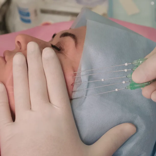 Нитевой лифтинг лица