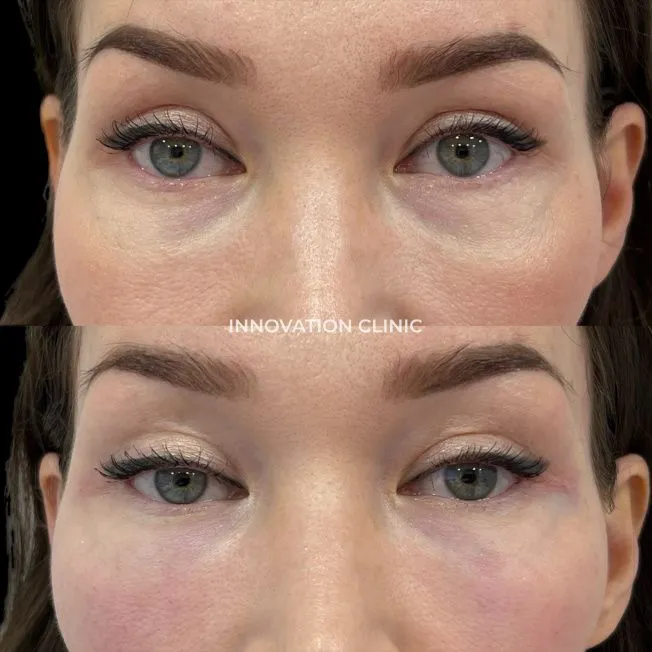 Коррекция носослёзной борозды фото до и после 1