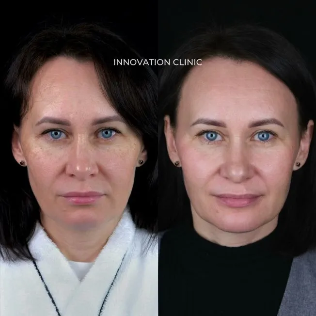 Протокол лечения пигментации фото до и после 