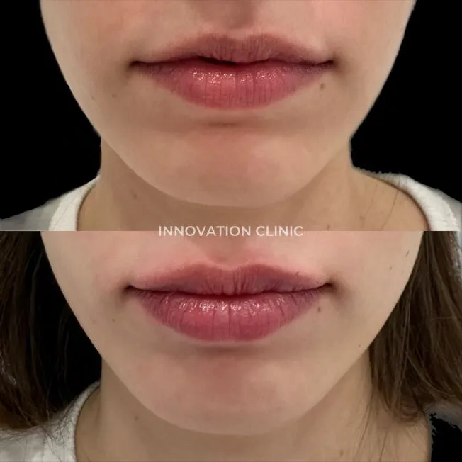 Коррекция формы губ филлером фото до и после 23