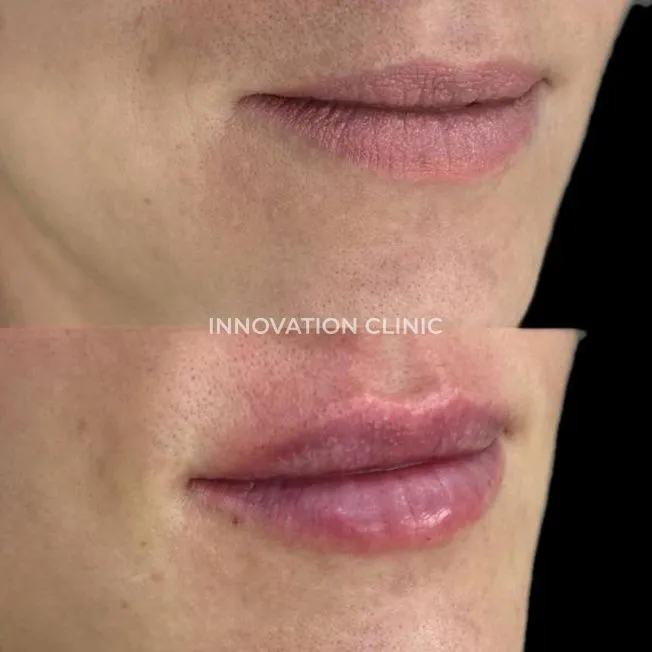 Коррекция формы губ филлером фото до и после 14