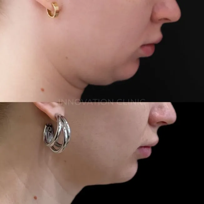 Малоинвазивный RF-лифтинг фото до и после 3