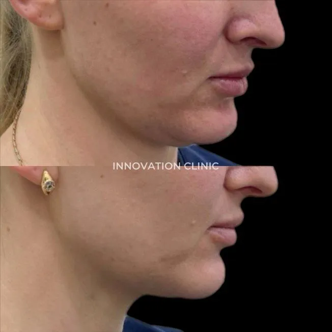 Устранение локальных жировых отложений фото до и после 2