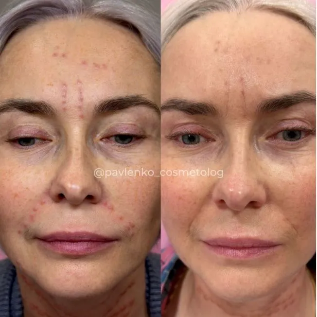 Лечение гранулемы инородного тела