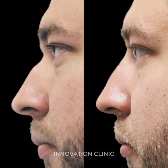 Коррекция спинки носа филлером фото до и после 1