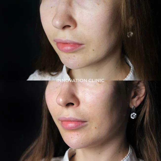 Коррекция подбородка филлером фото до и после 2