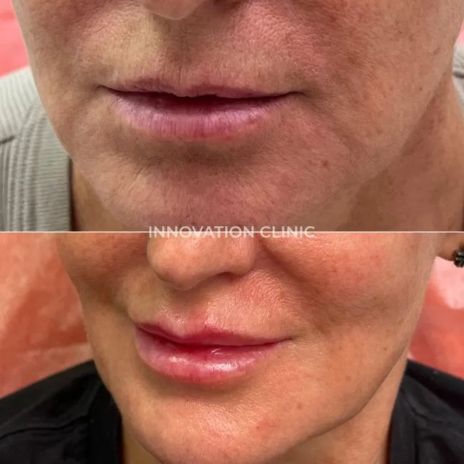 Коррекция формы губ филлером фото до и после 12