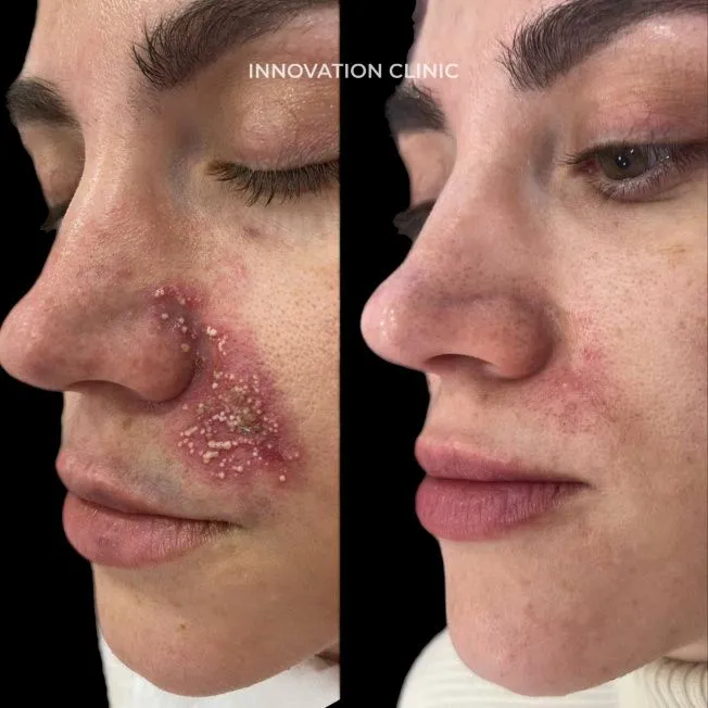 Лечение некроза кожи фото до и после 2