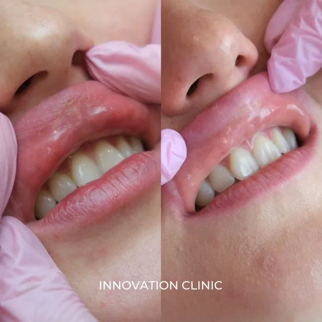 Удаление мигрировавшего филлера фото до и после 2